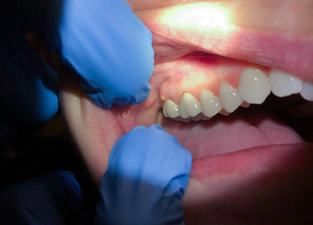 Best Emergency Tooth Extraction in Homestead Valley, CA